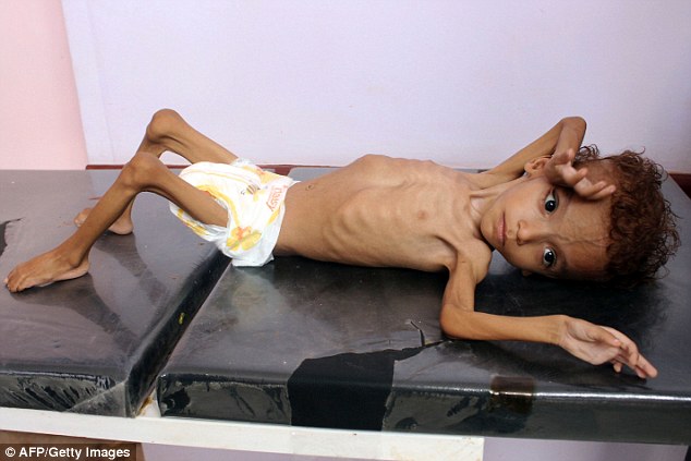 A malnourished child lying on a bed in a doctor's surgery in the northern Yemeni town of Abs on Saturday | AFP/ Getty Images